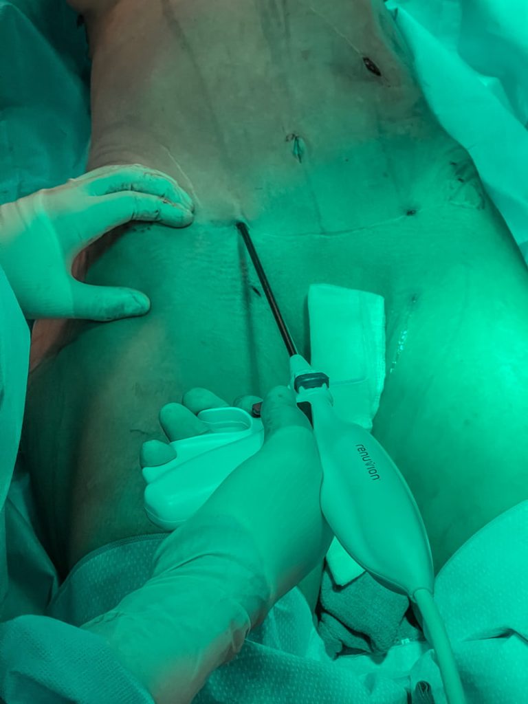 renuvion-in-action-1