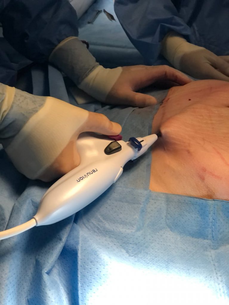 renuvion-in-action-2