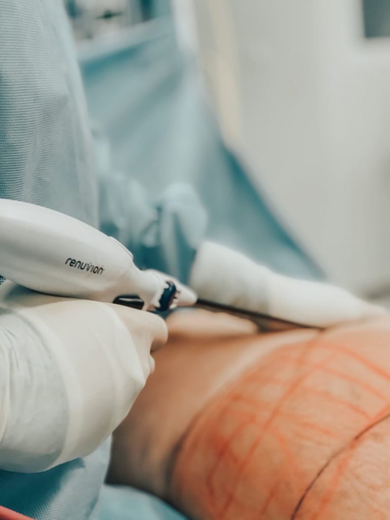 renuvion-in-action-5